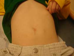 Appendix before connection to the belly button.